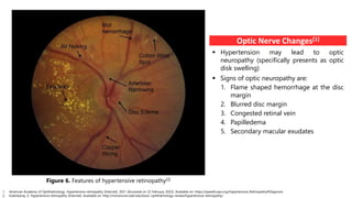 Figure 6. Features of hypertensive retinopathy[2]
1. American Academy of Ophthalmology. Hypertensive retinopathy [Internet]. 2021 [Accessed on 22 February 2022]. Available on: https://eyewiki.aao.org/Hypertensive_Retinopathy#Diagnosis
2. Kulenkamp, E. Hypertensive retinopathy [Internet]. Available on: http://morancore.utah.edu/basic-ophthalmology-review/hypertensive-retinopathy/
Optic Nerve Changes[1]
 Hypertension may lead to optic
neuropathy (specifically presents as optic
disk swelling)
 Signs of optic neuropathy are:
1. Flame shaped hemorrhage at the disc
margin
2. Blurred disc margin
3. Congested retinal vein
4. Papilledema
5. Secondary macular exudates
 