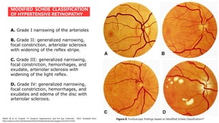 MODIFIED SCHEIE CLASSIFICATION
OF HYPERTENSIVE RETINOPATHY
Walsh JB et al. Chapter 13: Systemic Hypertension and the Eye. [Internet]. 2022. Available from:
http://www.oculist.net/downaton502/prof/ebook/duanes/pages/v3/v3c013.html
A. Grade I narrowing of the arterioles
B. Grade II: generalized narrowing,
focal constriction, arteriolar sclerosis
with widening of the reflex stripe.
C. Grade III: generalized narrowing,
focal constriction, hemorrhages, and
exudate, arteriolar sclerosis with
widening of the light reflex.
D. Grade IV: generalized narrowing,
focal constriction, hemorrhages, and
exudates and edema of the disc with
arteriolar sclerosis.
Figure 8. Funduscopic findings based on Modified Scheie Classification[2]
 