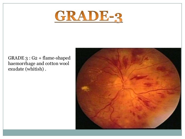 hypertensive retinopathy