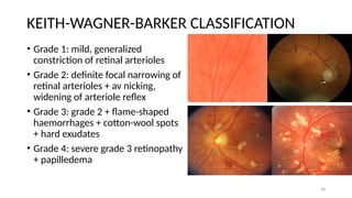 Hypertensive Retinopathy and Retinal Vein Occlusion -Dr. Prabhat ...