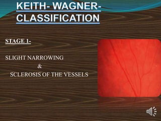 STAGE 1-
SLIGHT NARROWING
&
SCLEROSIS OF THE VESSELS
 