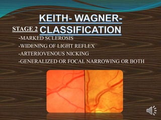 STAGE 2
-MARKED SCLEROSIS
-WIDENING OF LIGHT REFLEX
-ARTERIOVENOUS NICKING
-GENERALIZED OR FOCAL NARROWING OR BOTH
 