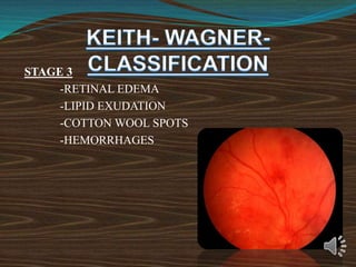 STAGE 3
-RETINAL EDEMA
-LIPID EXUDATION
-COTTON WOOL SPOTS
-HEMORRHAGES
 