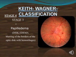 STAGE 4
STAGE 3
+
Papilledema
(DISK EDEMA
blurring of the borders of the
optic disk with hemorrhages)
 