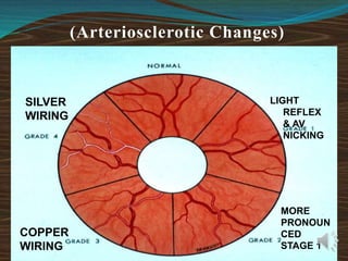 (Arteriosclerotic Changes)
LIGHT
REFLEX
& AV
NICKING
MORE
PRONOUN
CED
STAGE 1
COPPER
WIRING
SILVER
WIRING
 
