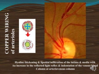 COPPER
WIRING
of
arterioles
Hyaline thickening & lipoidal infiltration of the intima & media with
An increase in the reflected light reflex & indentation of the venous blood
Column at arteriovenous column
 