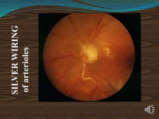 SILVER
WIRING
of
arterioles
 