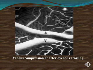 Venous compression at arteriovenous crossing
 