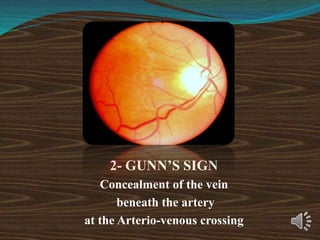 2- GUNN’S SIGN
Concealment of the vein
beneath the artery
at the Arterio-venous crossing
 