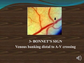 3- BONNET’S SIGN
Venous banking distal to A-V crossing
 