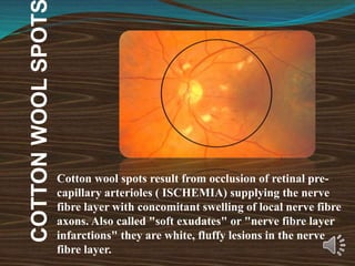 COTTON
WOOL
SPOT
Cotton wool spots result from occlusion of retinal pre-
capillary arterioles ( ISCHEMIA) supplying the nerve
fibre layer with concomitant swelling of local nerve fibre
axons. Also called "soft exudates" or "nerve fibre layer
infarctions" they are white, fluffy lesions in the nerve
fibre layer.
 