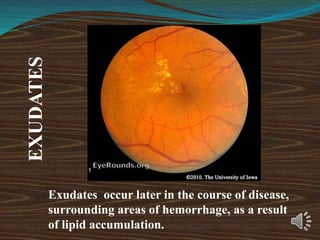 EXUDATES
Exudates occur later in the course of disease,
surrounding areas of hemorrhage, as a result
of lipid accumulation.
 