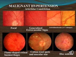 MALIGNANT HYPERTENSION
Cotton-wool spots
and macular star Disc oedema
Focal Generalized
Arteriolar Constriction
Extravascular Signs
Flame-shaped retinal
haemorrhages
Arteriolosclerosis (A-V changes)
 