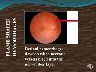 FLAME
SHAPED
HEMORRHAGES
Retinal hemorrhages
develop when necrotic
vessels bleed into the
nerve fiber layer
 