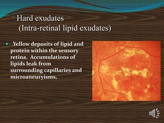 Hard exudates
(Intra-retinal lipid exudates)
 Yellow deposits of lipid and
protein within the sensory
retina. Accumulations of
lipids leak from
surrounding capillaries and
microaneuryisms,
 
