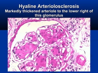 HyalineHyaline ArteriolosclerosisArteriolosclerosis
Markedly thickened arteriole to the lower right ofMarkedly thickened arteriole to the lower right of
this glomerulusthis glomerulus
 