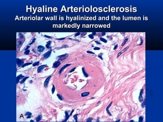 HyalineHyaline ArteriolosclerosisArteriolosclerosis
Arteriolar wall is hyalinized and the lumen isArteriolar wall is hyalinized and the lumen is
markedly narrowedmarkedly narrowed
 