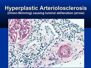 HyperplasticHyperplastic ArteriolosclerosisArteriolosclerosis
(Onion-Skinning) causing luminal obliteration (arrow)(Onion-Skinning) causing luminal obliteration (arrow)
 