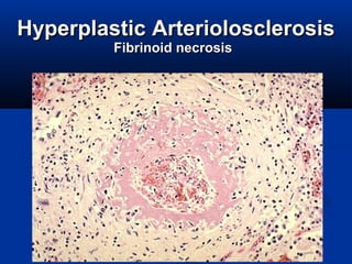 HyperplasticHyperplastic ArteriolosclerosisArteriolosclerosis
FFibrinoid necrosisibrinoid necrosis
 