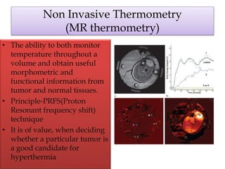 Non Invasive Thermometry
(MR thermometry)
• The ability to both monitor
temperature throughout a
volume and obtain useful
morphometric and
functional information from
tumor and normal tissues.
• Principle-PRFS(Proton
Resonant frequency shift)
technique
• It is of value, when deciding
whether a particular tumor is
a good candidate for
hyperthermia
 