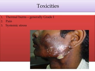 Toxicities
1. Thermal burns – generally Grade I
2. Pain
3. Systemic stress
 