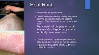 Heat Rash
 Also known as “Prickly Heat.”
 Occurs when sweat cannot freely evaporate
from the skin and sweat ducts become
plugged. This inflammation can cause a red
rash.
Red cluster of pimples or small
blister.- Can happen anywhere
on body. Neck/ Back/ Groin
 Can be prevented by wearing clothes that
allow sweat to evaporate as well as bathing
regularly and drying the skin. Can use
powder for comfort .
 