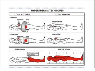 Hyperthermia in radiotherapy | PPTX