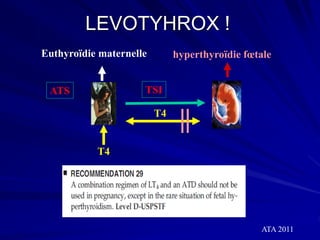 Euthyroïdie maternelle
TSI
hyperthyroïdie fœtale
T4
T4
LEVOTYHROX !
ATA 2011
ATS
 