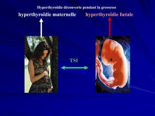 hyperthyroïdie maternelle
TSI
hyperthyroïdie fœtale
Hyperthyroïdie découverte pendant la grossesse
 