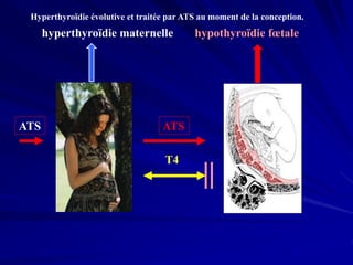 hyperthyroïdie maternelle hypothyroïdie fœtale
T4
Hyperthyroïdie évolutive et traitée par ATS au moment de la conception.
ATS ATS
 