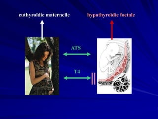 euthyroïdie maternelle
ATS
hypothyroïdie foetale
T4
 