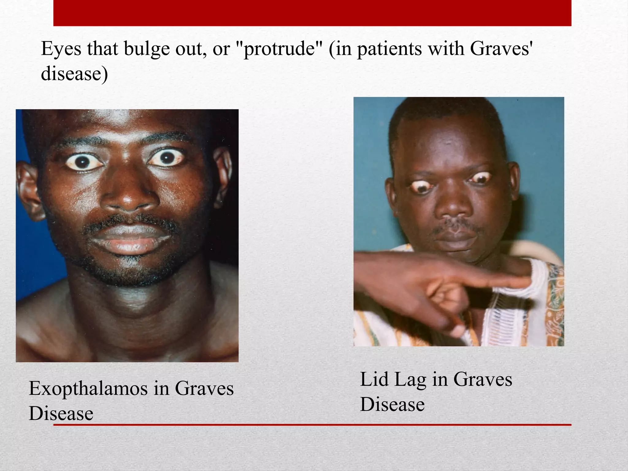 Exopthalamos in Graves
Disease
Lid Lag in Graves
Disease
Eyes that bulge out, or "protrude" (in patients with Graves'
disease)
 