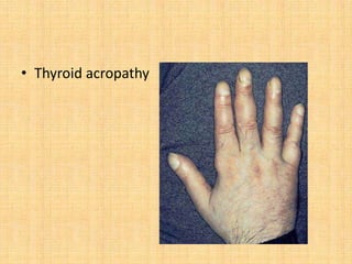 • Thyroid acropathy
 