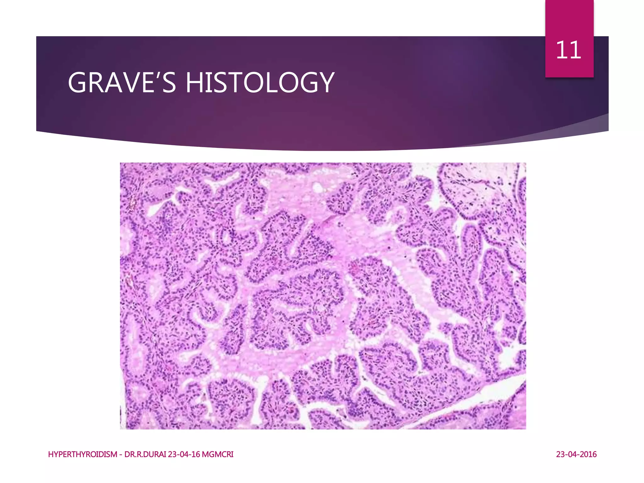 GRAVE’S HISTOLOGY
HYPERTHYROIDISM - DR.R.DURAI 23-04-16 MGMCRI
11
23-04-2016
 