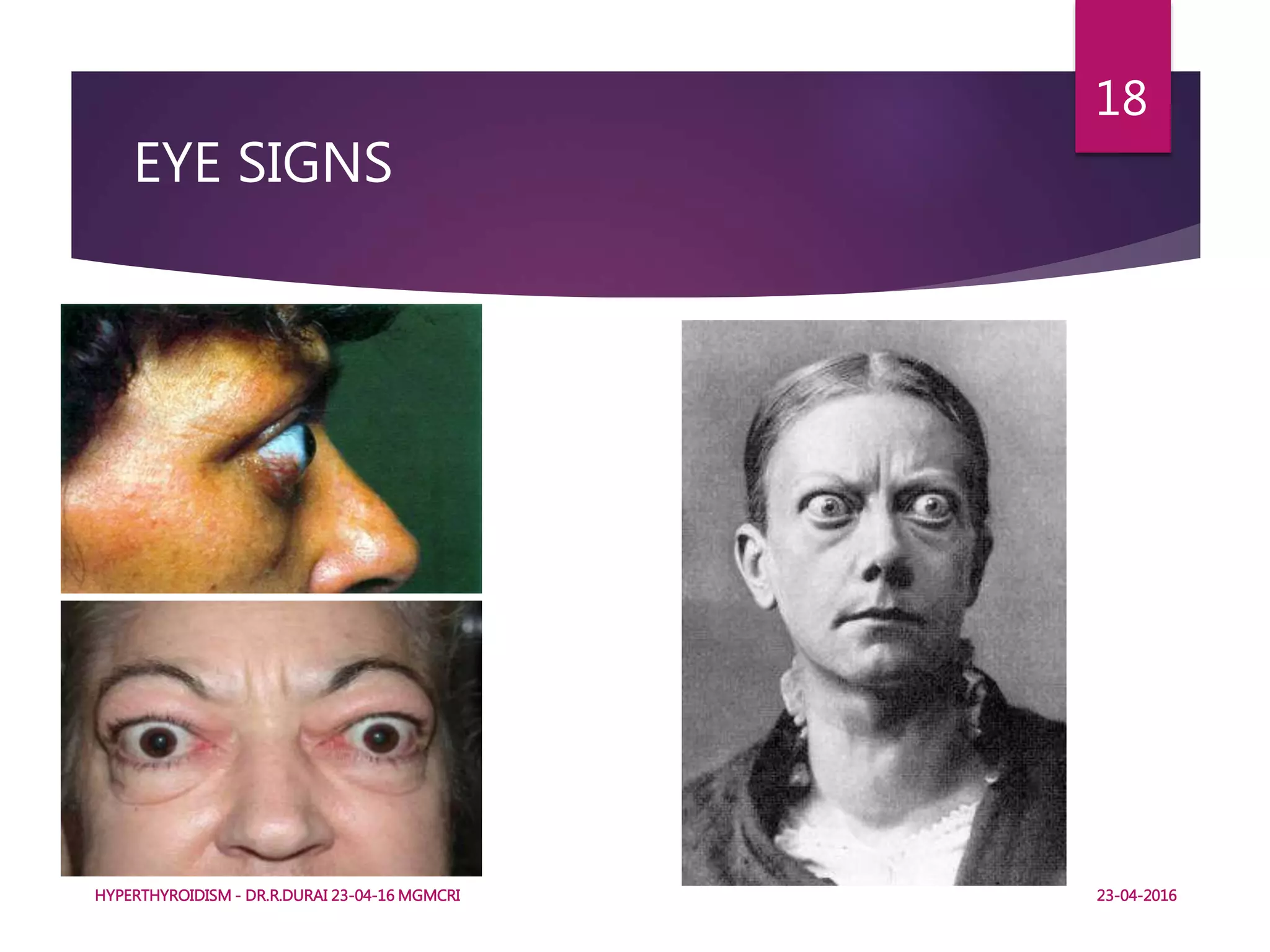 EYE SIGNS
HYPERTHYROIDISM - DR.R.DURAI 23-04-16 MGMCRI
18
23-04-2016
 