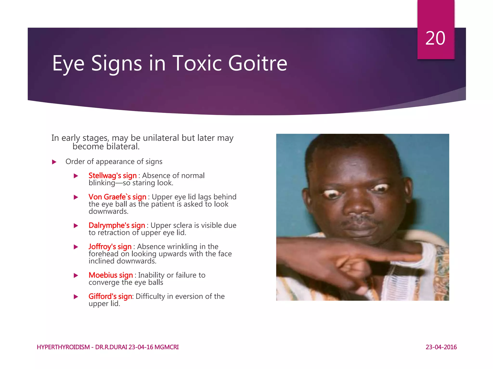 Eye Signs in Toxic Goitre
In early stages, may be unilateral but later may
become bilateral.
 Order of appearance of signs
 Stellwag's sign : Absence of normal
blinking—so staring look.
 Von Graefe`s sign : Upper eye lid lags behind
the eye ball as the patient is asked to look
downwards.
 Dalrymphe's sign : Upper sclera is visible due
to retraction of upper eye lid.
 Joffroy's sign : Absence wrinkling in the
forehead on looking upwards with the face
inclined downwards.
 Moebius sign : Inability or failure to
converge the eye balls
 Gifford's sign: Difficulty in eversion of the
upper lid.
HYPERTHYROIDISM - DR.R.DURAI 23-04-16 MGMCRI
20
23-04-2016
 