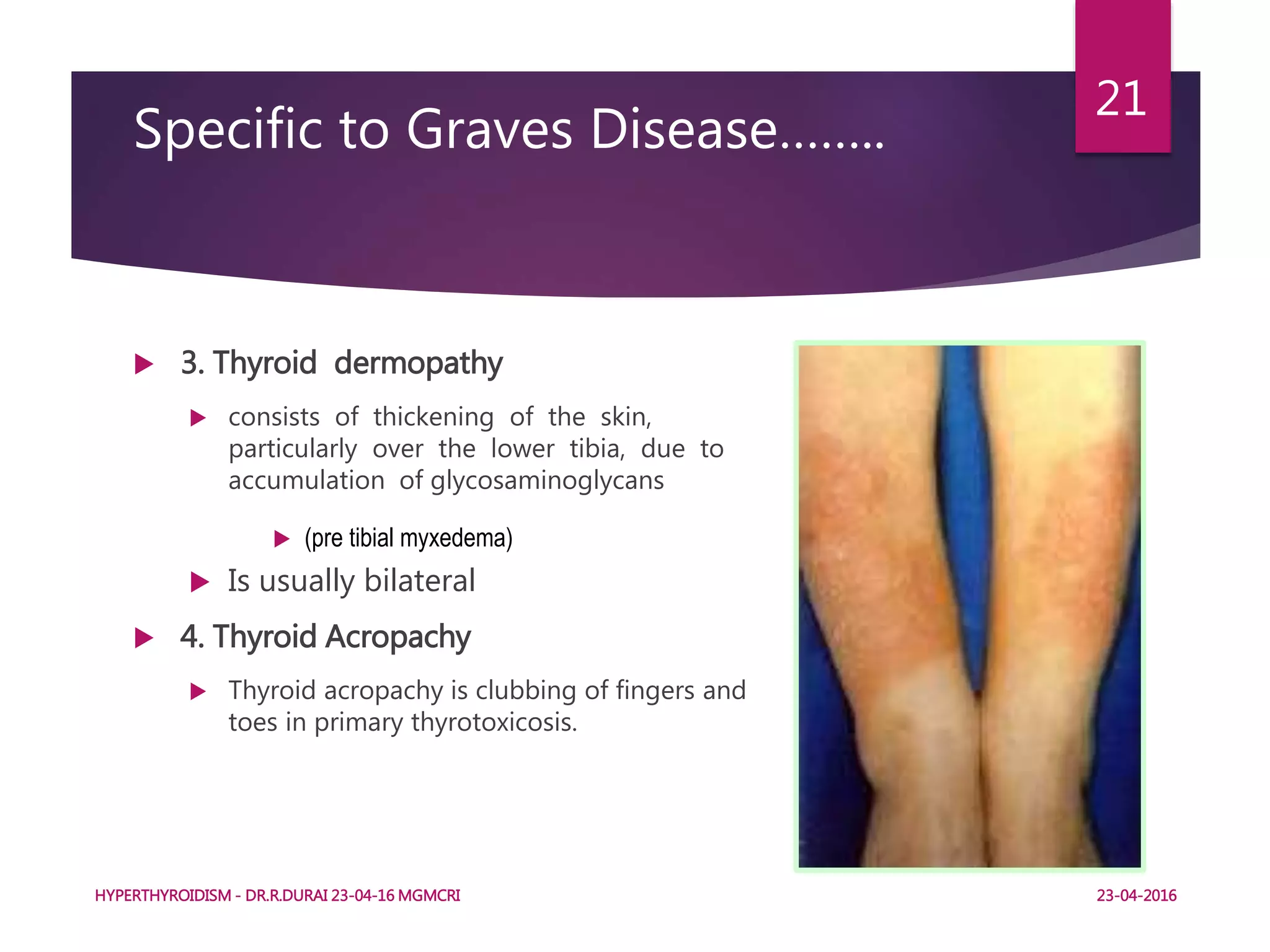 Specific to Graves Disease……..
 3. Thyroid dermopathy
 consists of thickening of the skin,
particularly over the lower tibia, due to
accumulation of glycosaminoglycans
 (pre tibial myxedema)
 Is usually bilateral
 4. Thyroid Acropachy
 Thyroid acropachy is clubbing of fingers and
toes in primary thyrotoxicosis.
HYPERTHYROIDISM - DR.R.DURAI 23-04-16 MGMCRI
21
23-04-2016
 