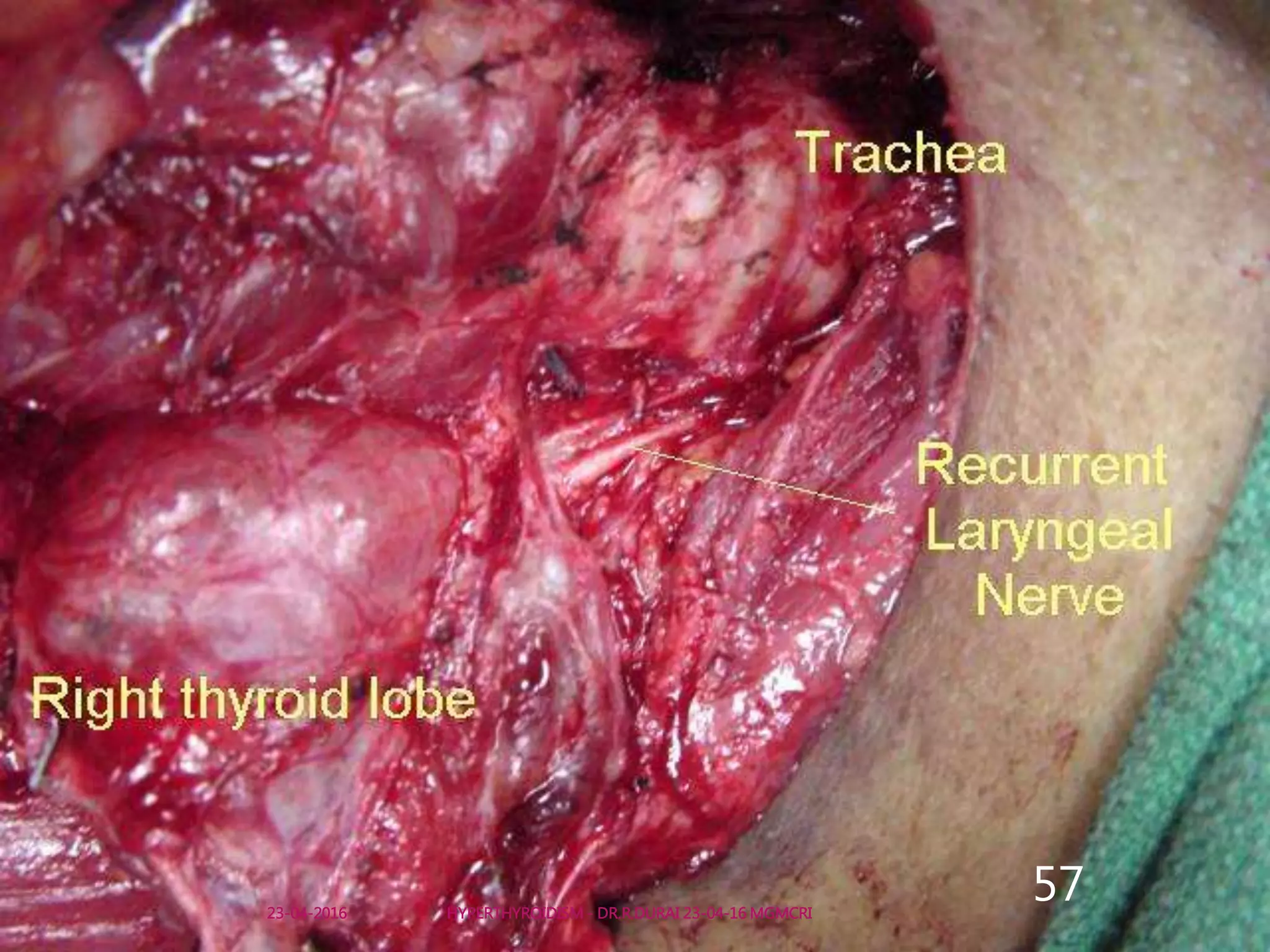 HYPERTHYROIDISM - DR.R.DURAI 23-04-16 MGMCRI
5723-04-2016
 