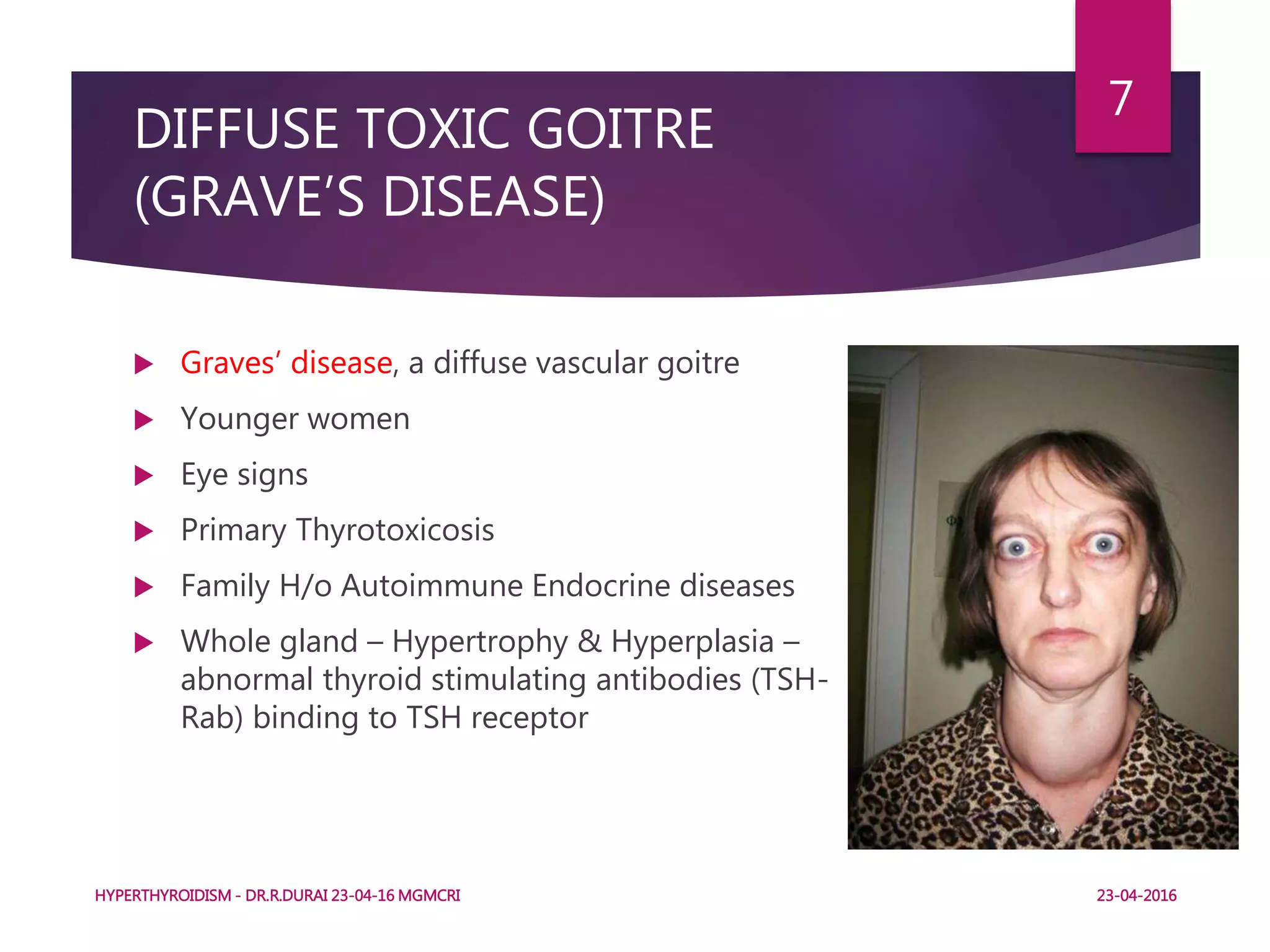DIFFUSE TOXIC GOITRE
(GRAVE’S DISEASE)
 Graves’ disease, a diffuse vascular goitre
 Younger women
 Eye signs
 Primary Thyrotoxicosis
 Family H/o Autoimmune Endocrine diseases
 Whole gland – Hypertrophy & Hyperplasia –
abnormal thyroid stimulating antibodies (TSH-
Rab) binding to TSH receptor
HYPERTHYROIDISM - DR.R.DURAI 23-04-16 MGMCRI
7
23-04-2016
 
