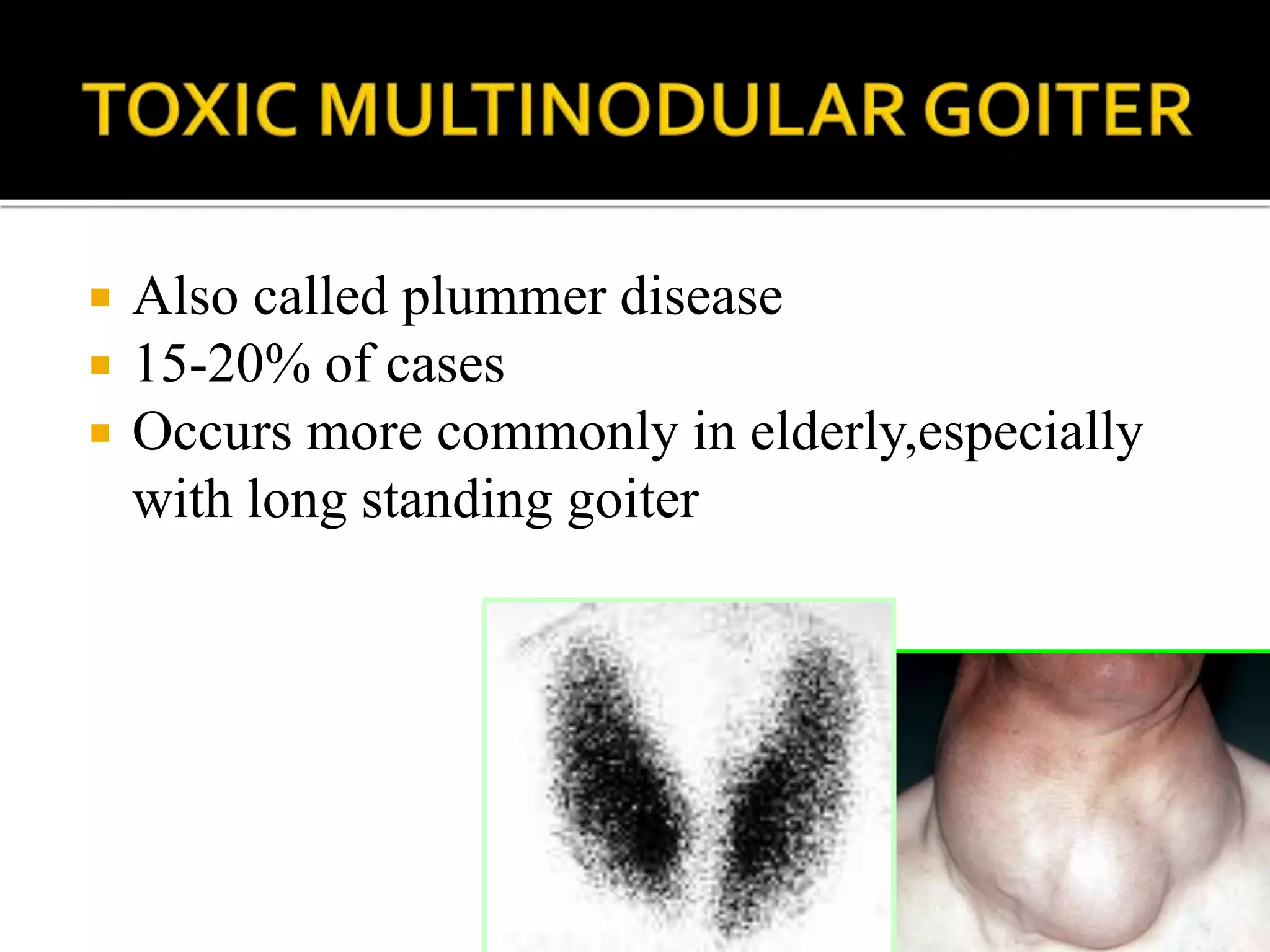 Hyperthyroidism | PPTX