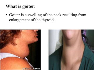 Hyperthyroidism | PPTX