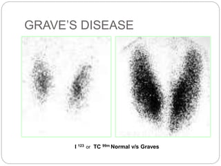 GRAVE’S DISEASE
I 123 or TC 99m Normal v/s Graves
 