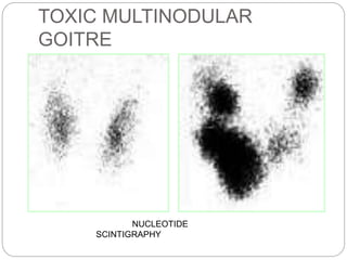 TOXIC MULTINODULAR
GOITRE
NUCLEOTIDE
SCINTIGRAPHY
 