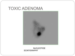 TOXIC ADENOMA
NUCLEOTIDE
SCINTIGRAPHY
 