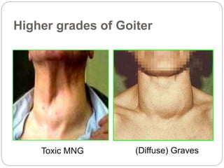 Higher grades of Goiter
Toxic MNG (Diffuse) Graves
 