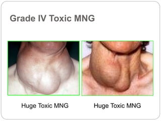 Grade IV Toxic MNG
Huge Toxic MNG Huge Toxic MNG
 