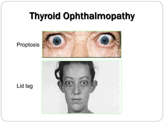 Proptosis
Lid lag
Thyroid Ophthalmopathy
 
