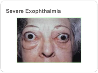 Severe Exophthalmia
 