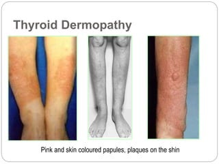 Thyroid Dermopathy
Pink and skin coloured papules, plaques on the shin
 