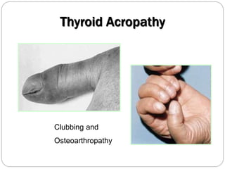 Clubbing and
Osteoarthropathy
Thyroid Acropathy
 